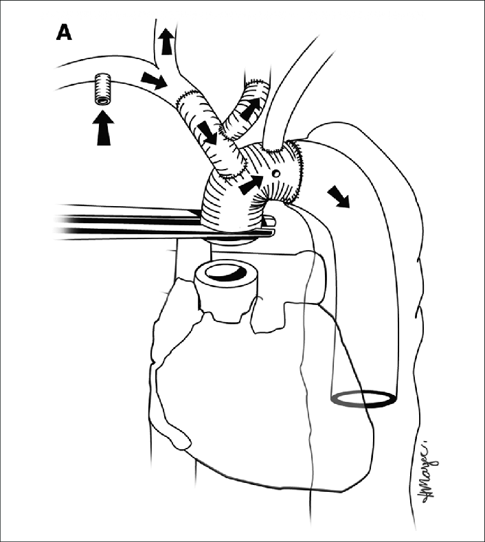 706x789 A. Schematic Drawing Of Anastamosis Of Ascending Arch Tube Graft