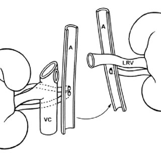 320x320 Schematic Drawings Demonstrating That Elongation Of The Right