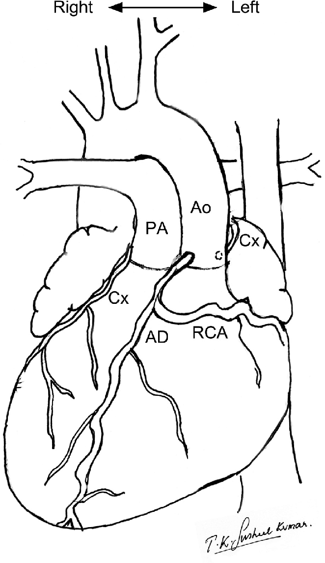 662x1145 This Drawing Of The External Cardiac Anatomy Shows Dextrocardia