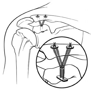 320x320 Line Drawing Of Native Shoulder Joints With Intact