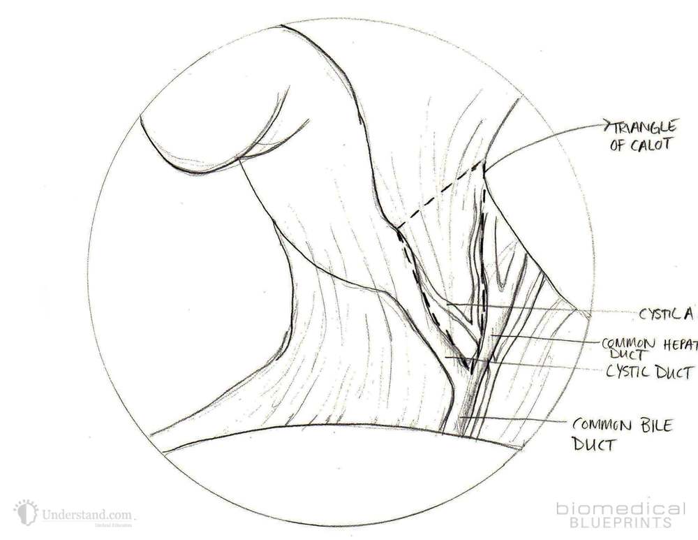 1000x773 Gallbladder Anatomy Amp Surgical Complications Artists' Blogs