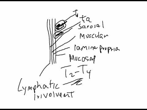 480x360 Diagnosis And Treatment For Gallbladder Cancer