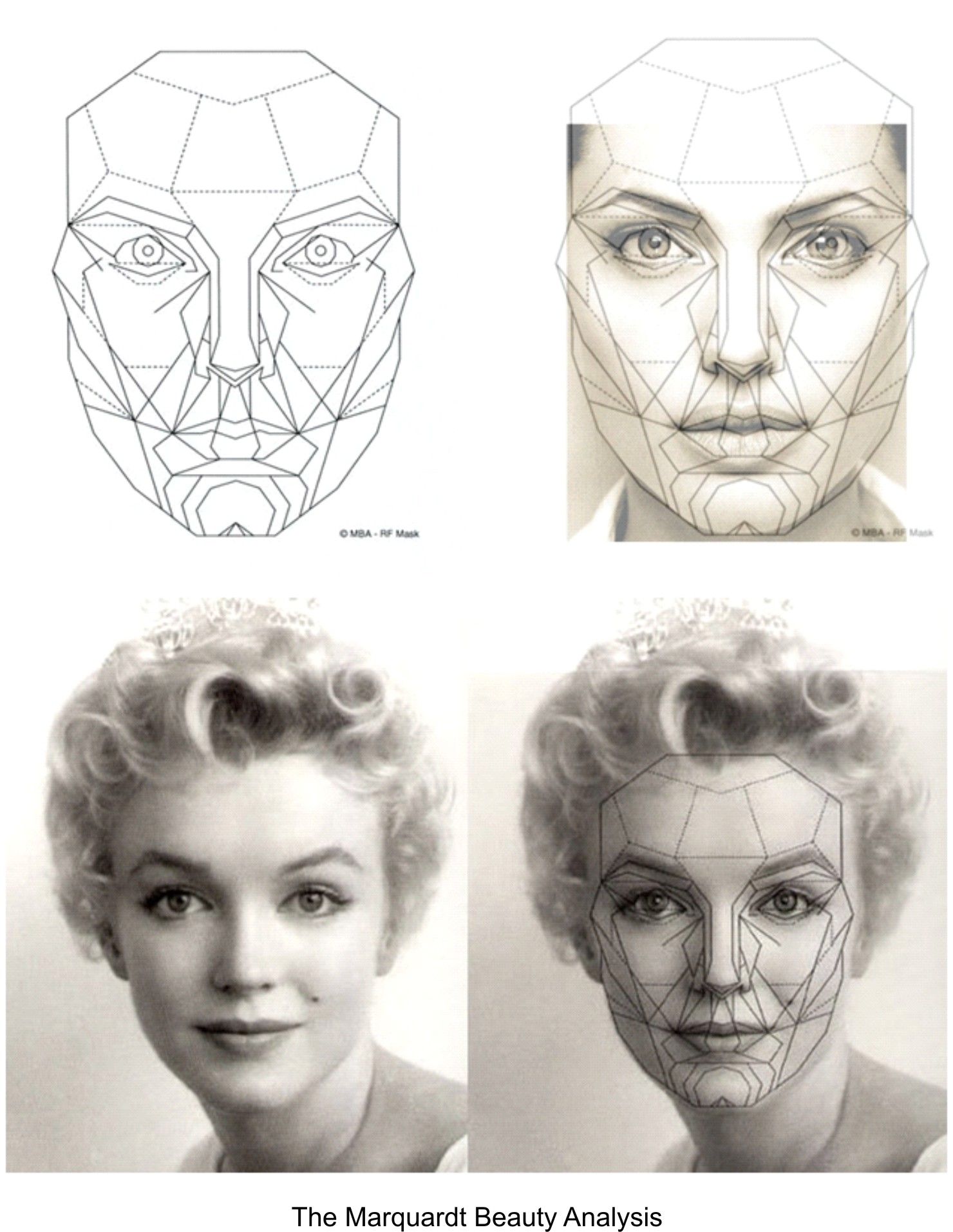 1480x1913 What Accounts For Beauty Marquardt Mask Changes Plastic Surgery
