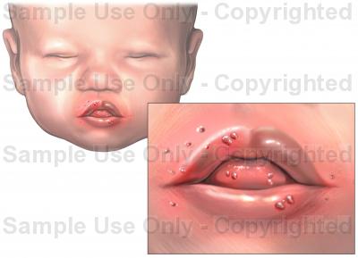 400x289 Hand, Foot And Mouth Disease