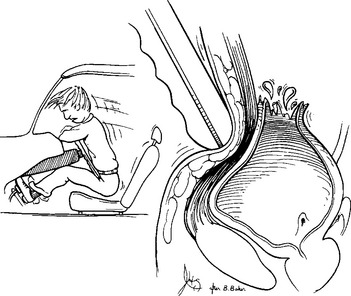 351x296 Genitourinary Injuries And Renal Management Musculoskeletal Key