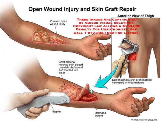 550x425 Amicus Illustration Of Amicus,surgery,open,wound,injury,skin,graft
