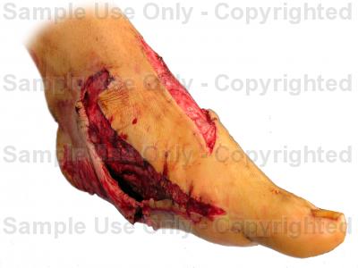 400x300 Degloving Injury To The Foot
