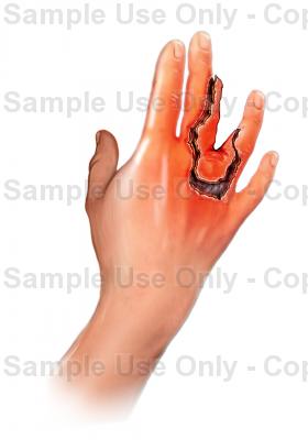 280x400 Hand Injury Dog Bite