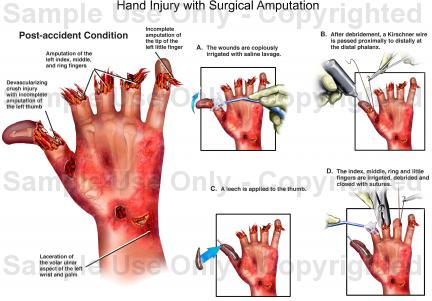 432x301 Hand Injury With Surgical Amputation