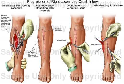 432x293 Progression Of Right Lower Leg Crush Injury