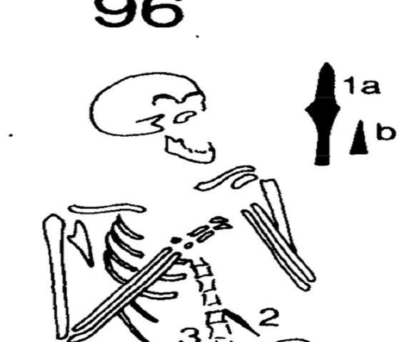 556x480 Clues Revealed About An Ancient Case Of Leprosy
