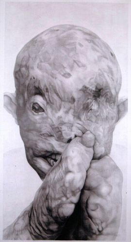 270x496 114 Best Leprosy Hansen's Disease Images