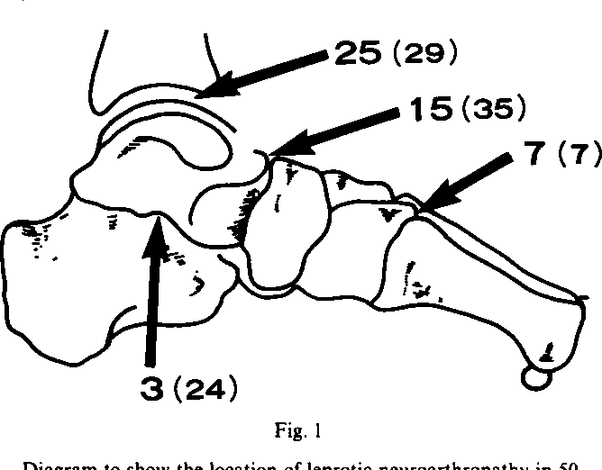 668x522 Figure 4 From Neuroarthropathy Of The Foot In Leprosy.