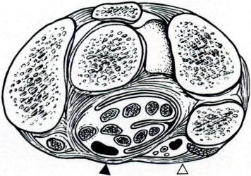 356x250 Drawing Of Axial View Of Carpal Tunnel And Guyon's Canal