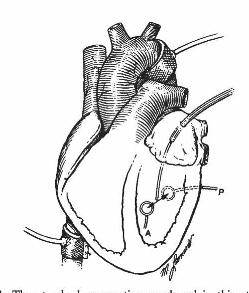 496x584 Figure 7 From Mechanical Correlates Of The Third Heart Sound