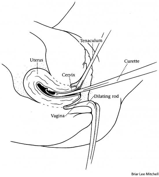 550x614 Misoprostol Miscarriage Timeline