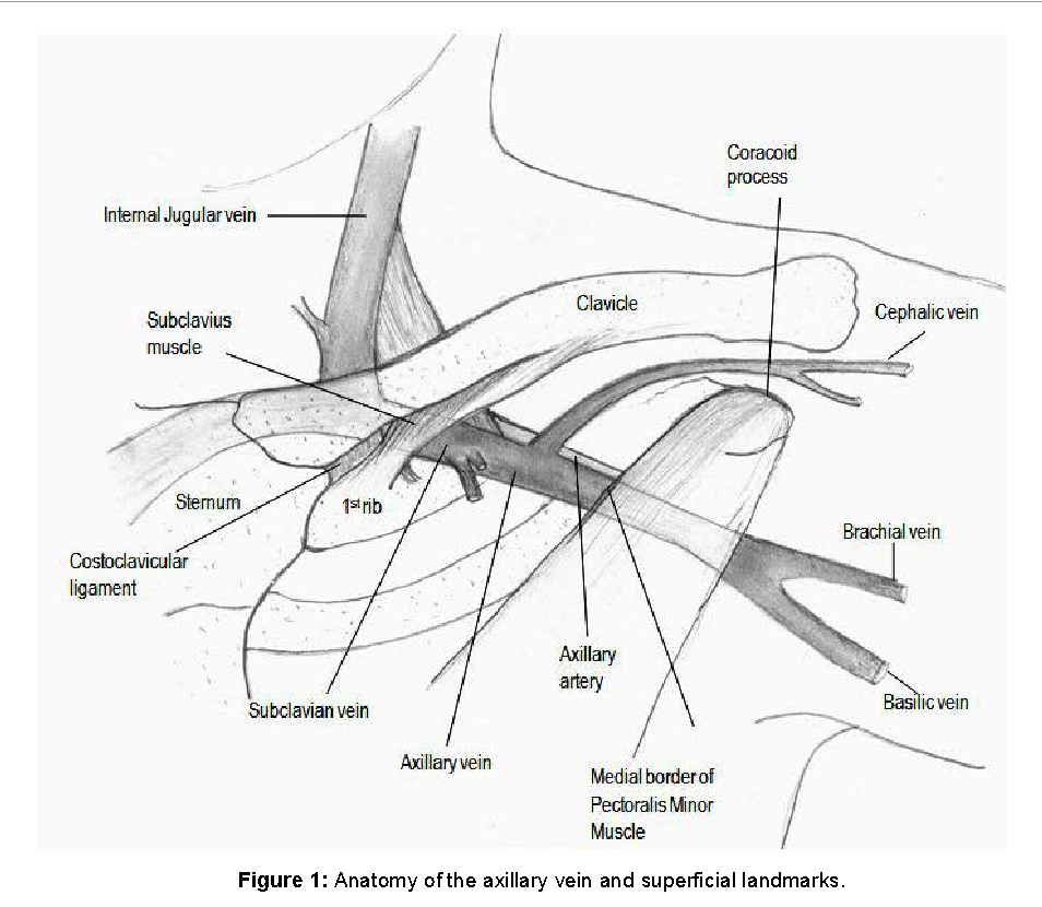 954x830 Fluoroscopy Guided Axillary Vein Puncture , A Reliable Method