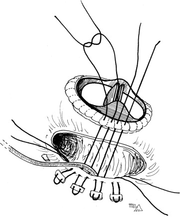 361x436 Long Term Follow Up Of Permanent Transvenous Pacing Systems