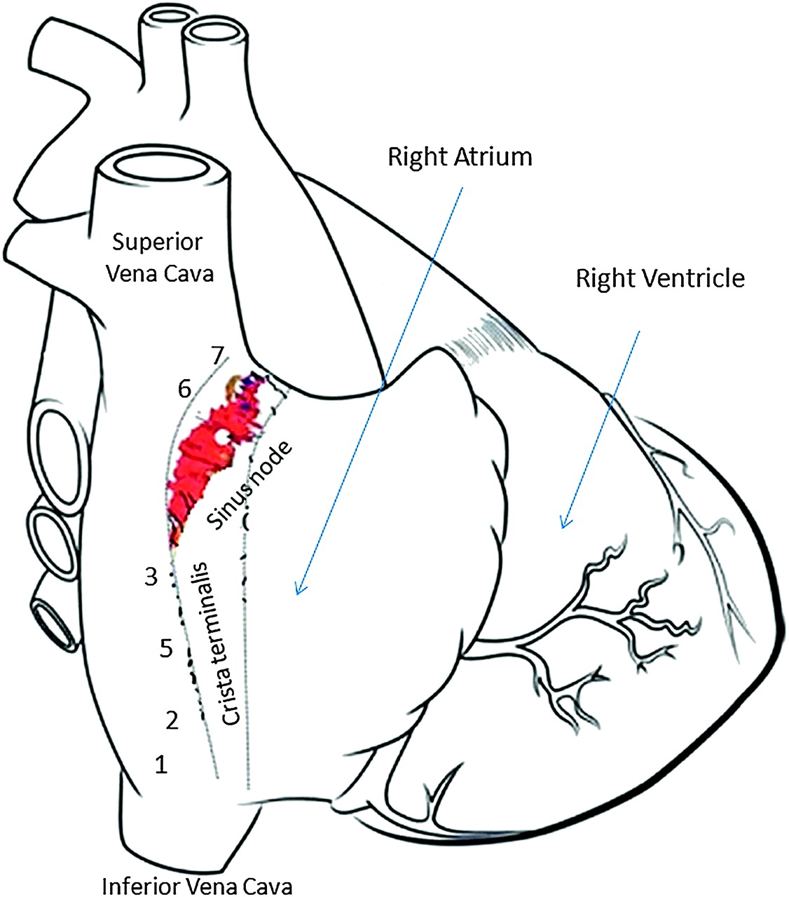 1126x1280 112 Location Subsidiary Atrial Pacemakers Following Ablation