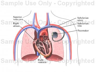 400x300 Pacemaker