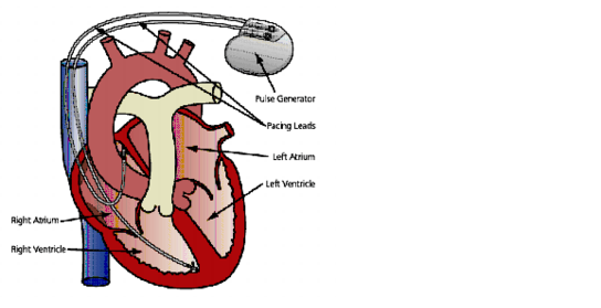544x279 Pacemaker Electrode