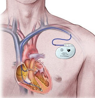 316x326 Pacemaker Implant After Heart Valve Surgery Amp Maze Procedure