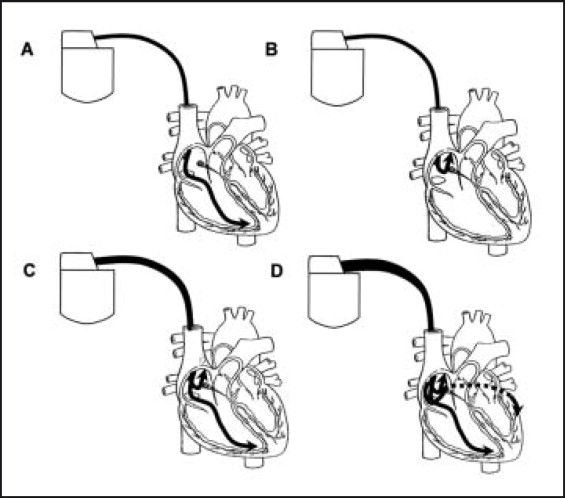 565x498 Contemporary Pacemakers What The Primary Care Physician Needs