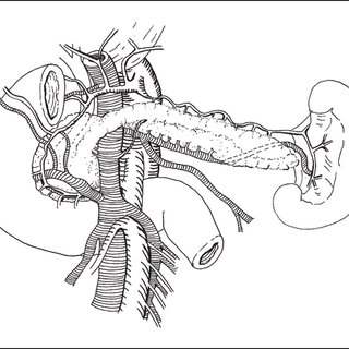 320x320 Pdf) Surgical Therapy In Chronic Pancreatitis