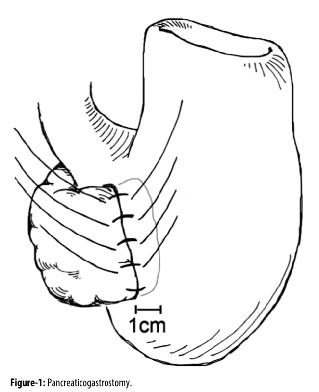 650x799 Pancreaticogastrostomy