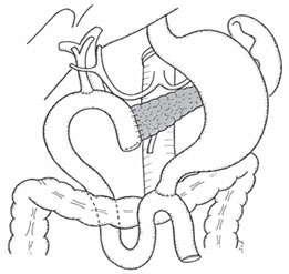 261x247 Surgery For Pancreatic Cancer