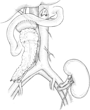 376x458 Whole Organ Pancreas And Pancreatic Islet Transplantation