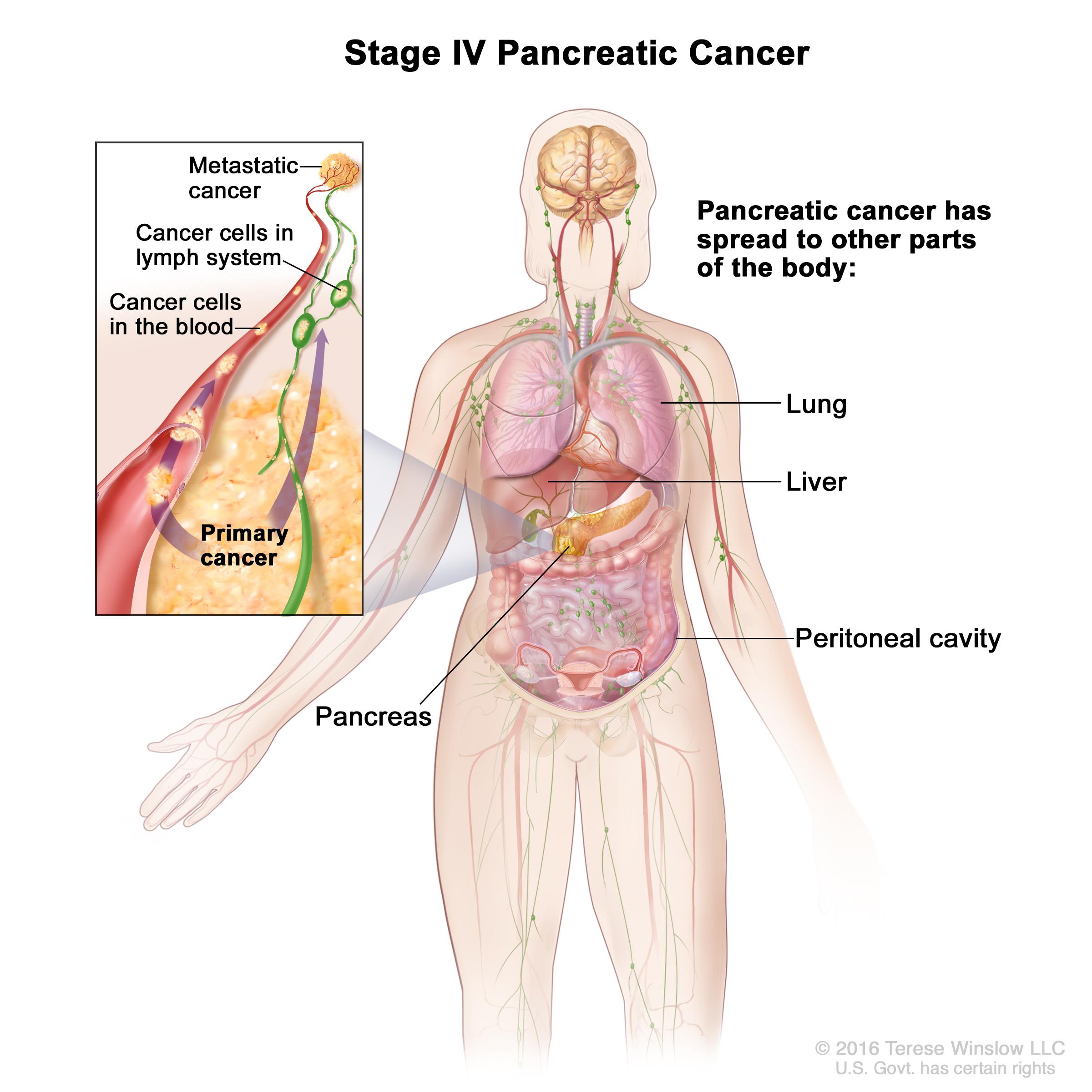 2400x2400 Pancreatic Cancer Treatment (Patients) Oncolink