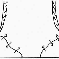 241x241 Schematic Drawing Of The Patch Clamp Technique In Whole Cell