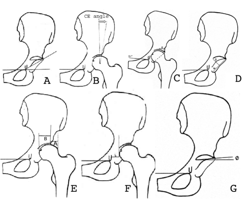 492x411 Schematic Drawing Of The Hip Joint Showing Sharp's Acetabular