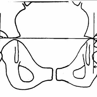 320x320 Reimers Migration Percentage Is Calculated From An Anteroposterior