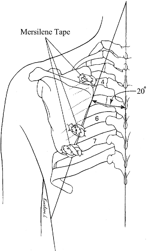 486x830 Polyester Tape Scapulopexy For Chronic Upper Extremity Brachial