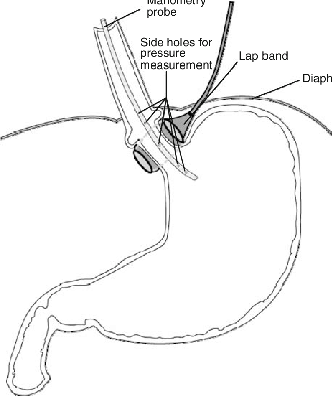659x786 Sketch Of The Adjustable Band Creating The Pouch Download