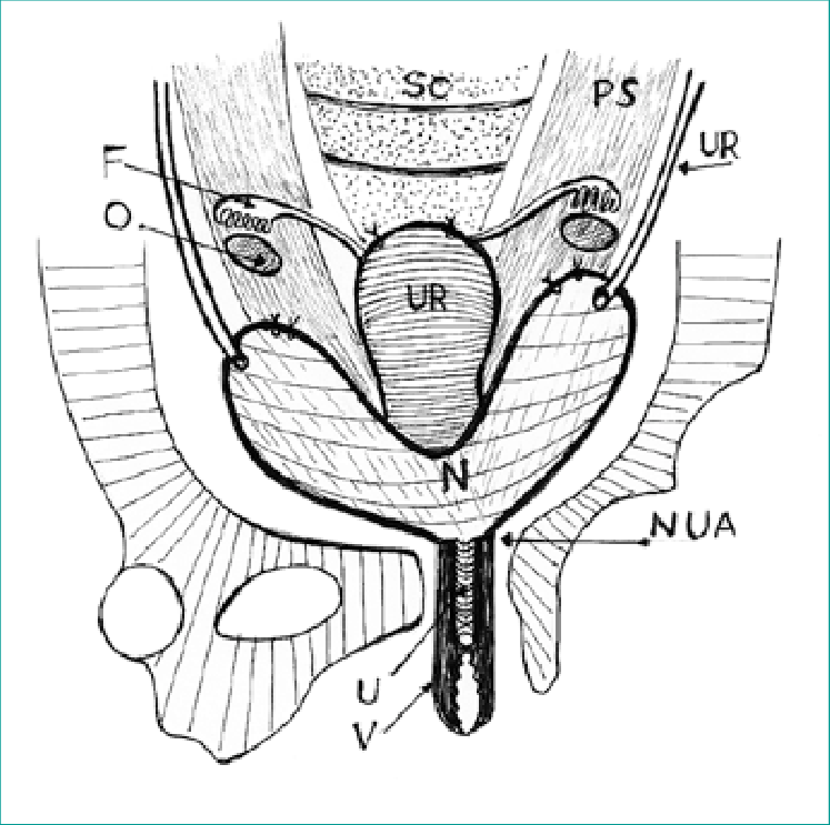 747x743 Final View Of The Procedure Of Female Genital Sparing Cystectomy