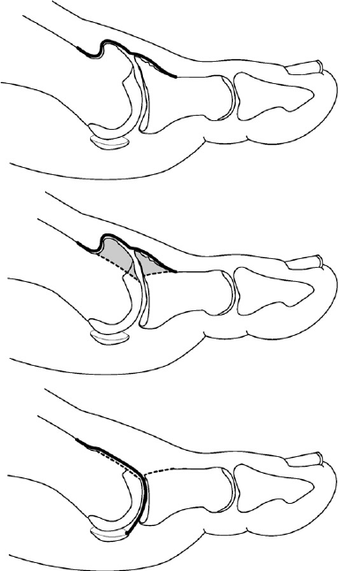 383x646 Sequential Drawings Illustrating Interpositional Arthroplasty