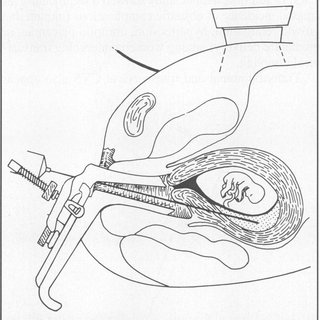 320x320 The Drawing Shows The Transabdominal Chorionic Villus Sampling