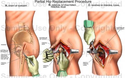 432x271 Partial Hip Replacement Procedure