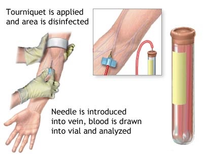 400x320 Step By Step Procedure For How A Phlebotomist Draws Blood
