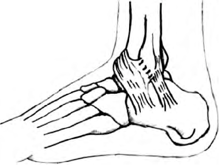 448x338 Drawing Of Semi Single Modified Brostrom Procedure Without