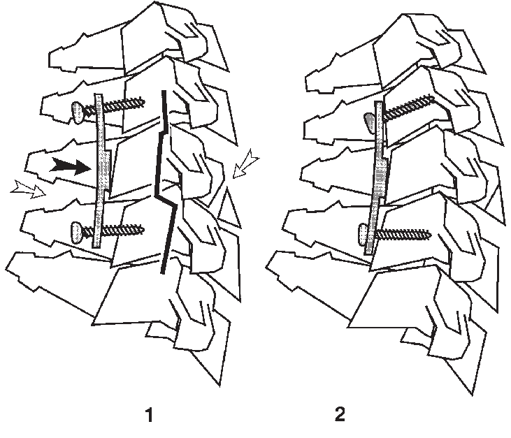 731x627 Reduction And Fixation Effect Of The Three Hole Cervical Plate