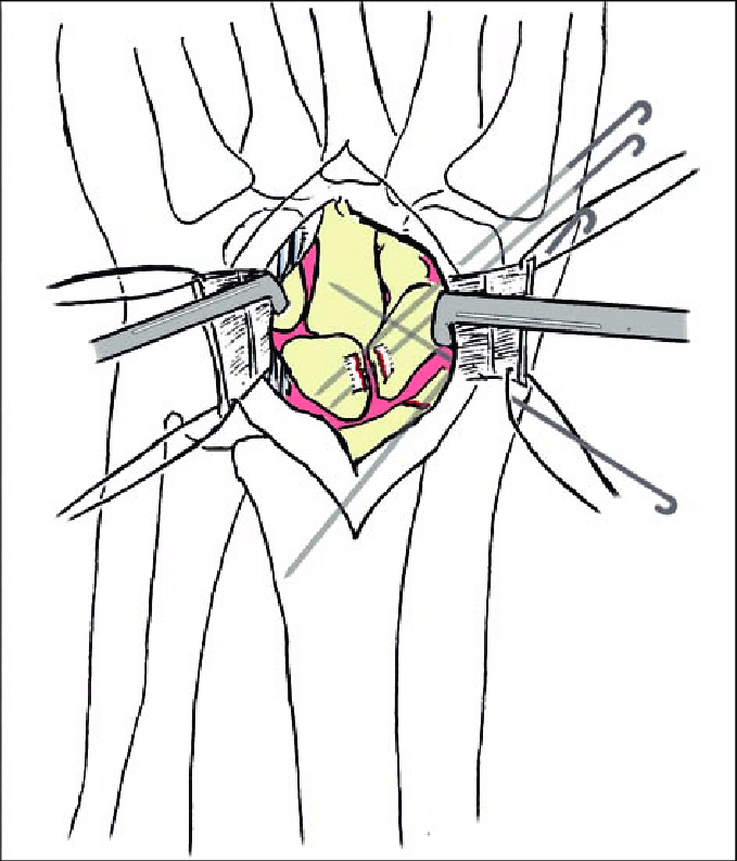 679x793 Reduction And Fixation Of The Radial Styloid Fracture (Single 1.6
