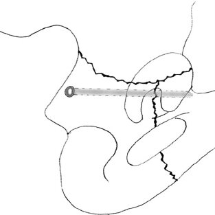 313x313 Schematic Drawing On The Use Of Spring Plates. ( A ) One Third