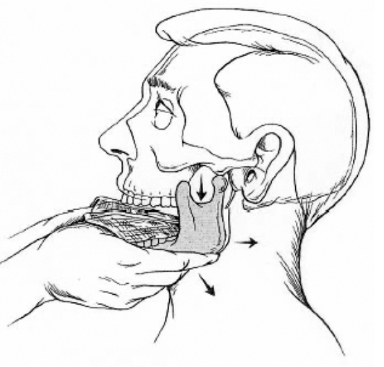 554x529 4 Reduction Techniques Of Anterior Mandible Dislocation Sinaiem