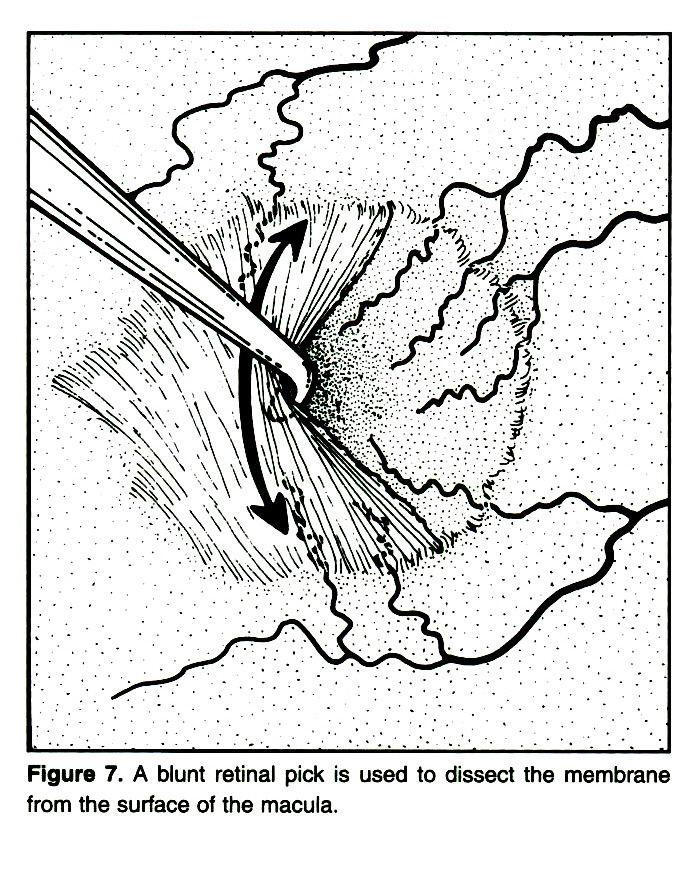 692x872 Epiretinal Fibrosis
