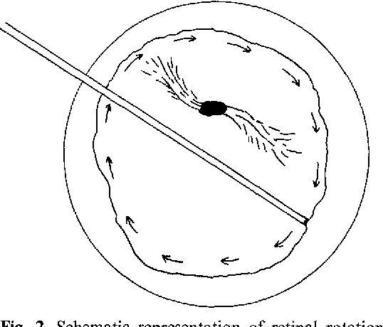 538x460 Figure 2 From Retinal Separation, Retinotomy, And Macular