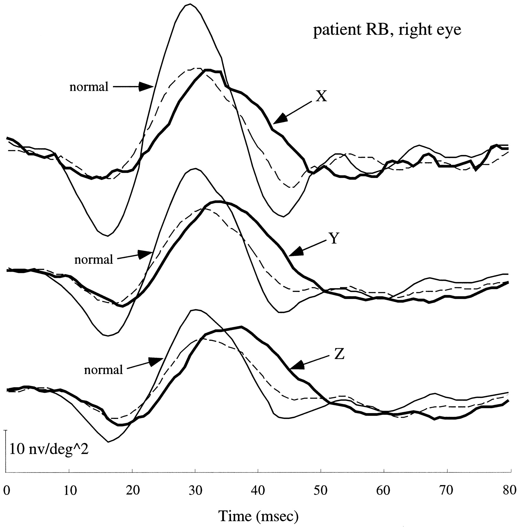 1770x1800 Multifocal Electroretinogram Delays Reveal Local Retinal